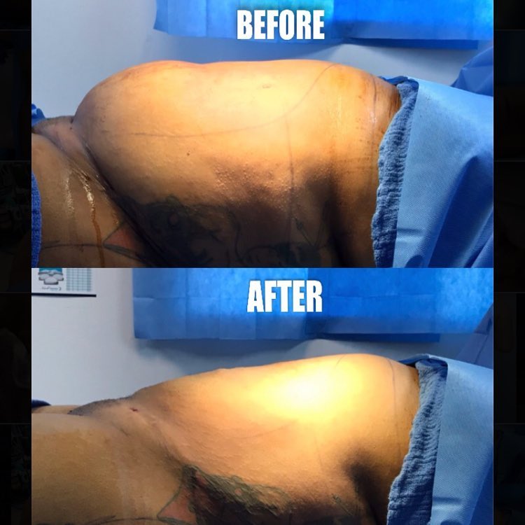 Instagram post by Dr. John E. Nees: Sometimes liposuction is all you need to start your summer body. 🌴☀️ #liposuction #plasticsurgery #boardcertified #beautifulbody