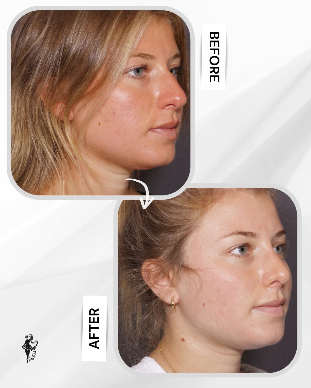 Instagram post by Dr. John E. Sherman: This rhinoplasty refined the patient’s profile while keeping her features balanced and natural. The goal was never to make her look like som…