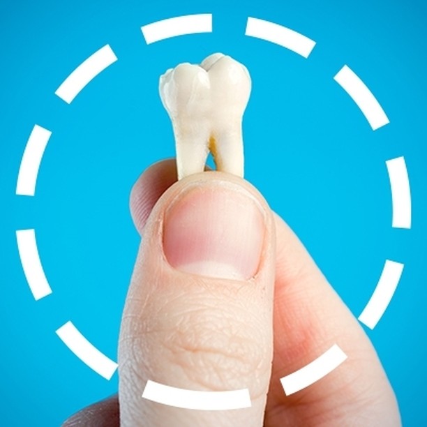 Instagram post by Dr. John Freeman: Single tooth extraction is sometimes necessary if a tooth has been severely damaged by decay or infection. In some cases, root canal treatme…
