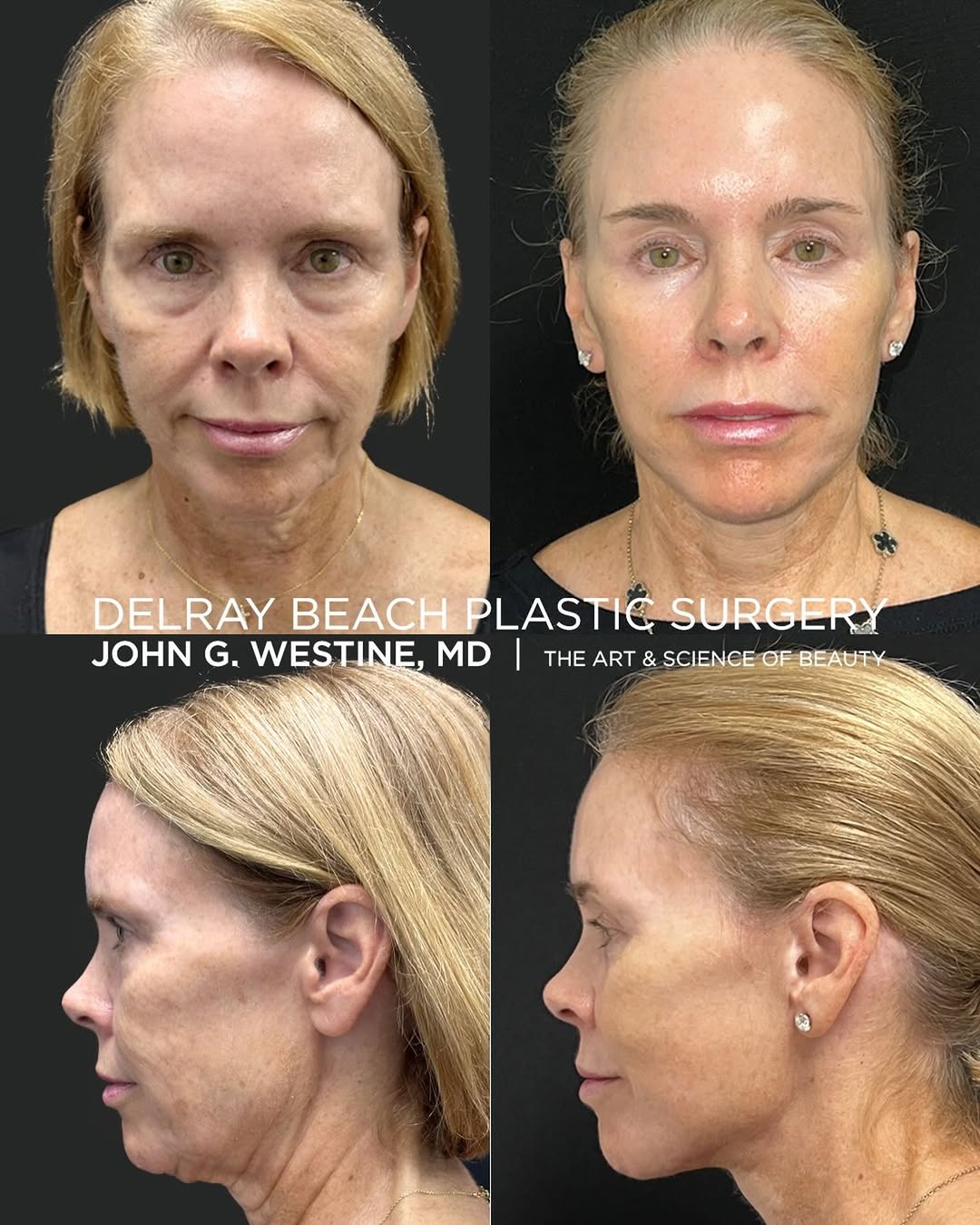 Instagram post by Dr. John G. Westine: Shazammmmm! 🔥🔥🔥 Lower face/neck lift, lower bleph, earlobe reduction, CO2 laser