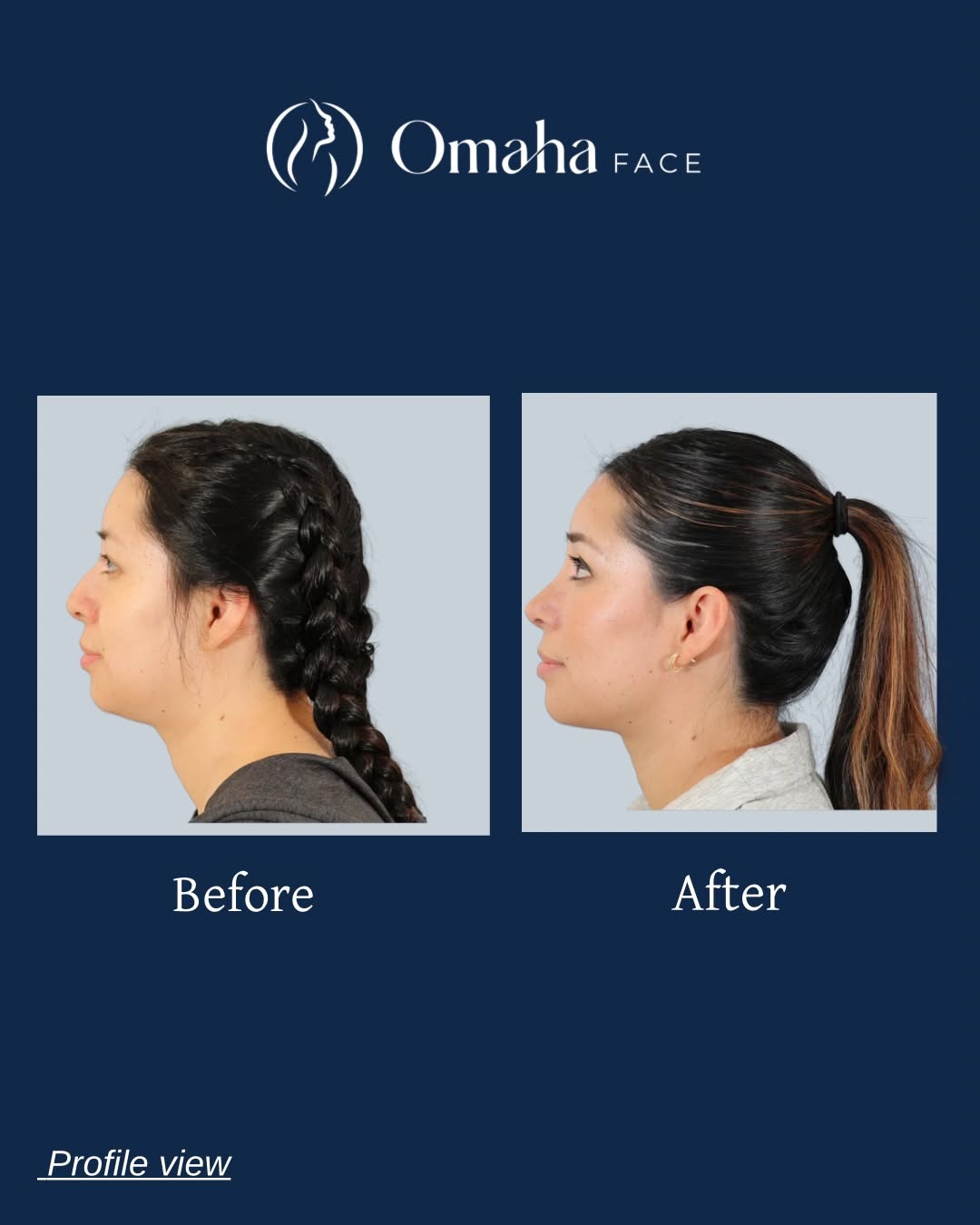 Instagram post by Dr. John Harbison: A refined rhinoplasty result from every angle. ✨ Subtle changes to the bridge and tip create a softer, more balanced profile while maintaini…