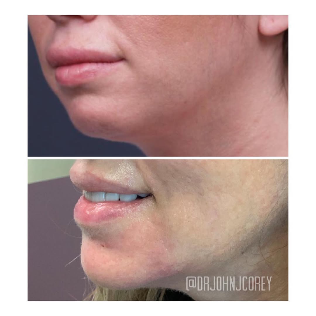 Instagram post by Dr. John J. Corey: Chin implants are not always the answer. You can get the same result without surgery or downtime. 2 syringes of Voluma for definition and p…