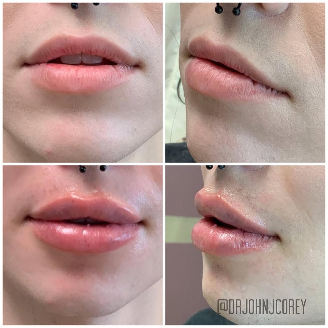 Instagram post by Dr. John J. Corey: It’s normal to have swelling after lip filler. This photo was taken immediately after treatment. The fullness in the white lip will settle …