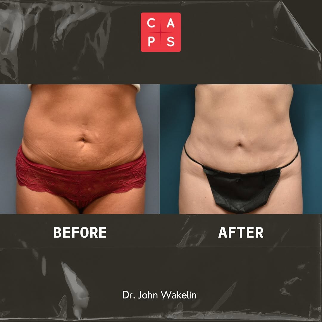 Instagram post by Dr. John K. Wakelin III: Ready for a change? A mini tummy tuck with abdominal liposuction can redefine your silhouette and boost your confidence. Swipe ➡️ for the in…