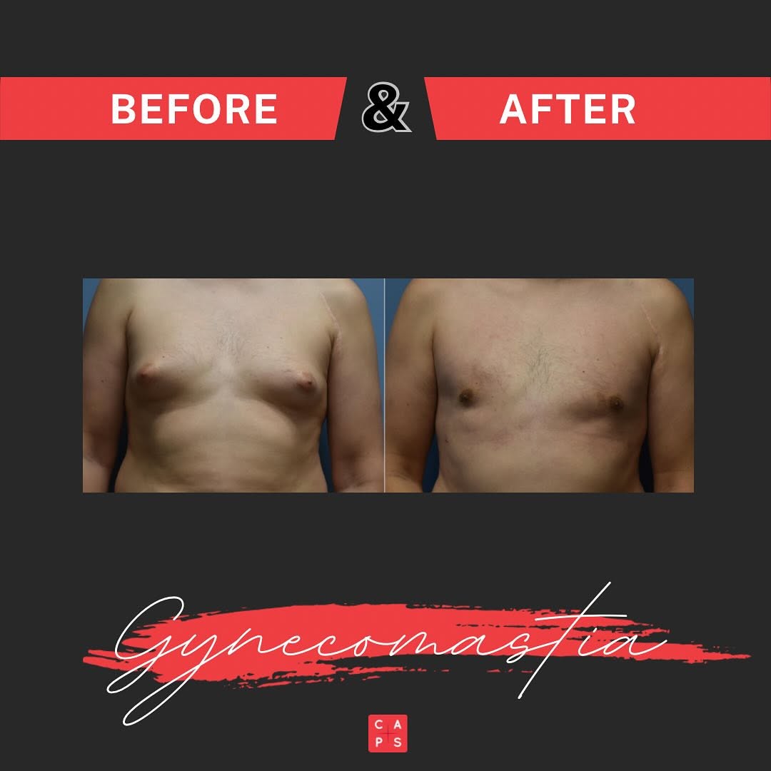 Instagram post by Dr. John K. Wakelin III: The results speak for themselves.✨ It’s not just about how you look, but how you feel. Male gynecomastia treatment can help you regain confi…