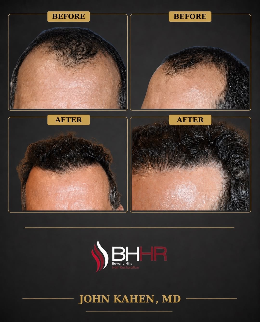 Instagram post by Dr. John Kahen: This patient underwent Follicular Unit Extraction (FUE) with 2,700 grafts, strategically placed to restore the hairline and improve overall …