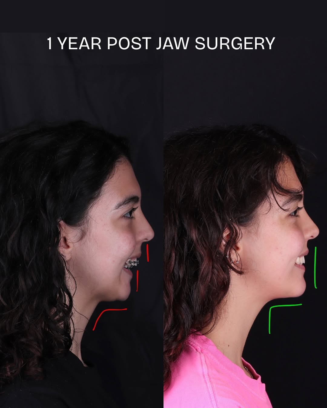 Instagram post by Dr. John Karotkin: An amazing result for an amazing person ™ #breathing #airway #sleepapnea #osa #oralsurgery #oralsurgeon #orthognathics