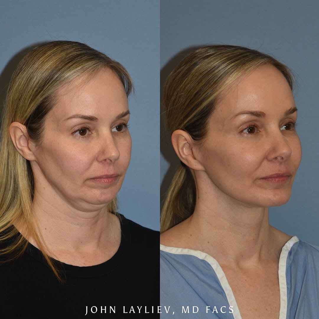Instagram post by Dr. John Layliev: ✨ 50, beautiful, and feeling more confident than ever! ✨ 1.5 years after a deep plane neck lift, chin implant, facelift, and facial fat graf…