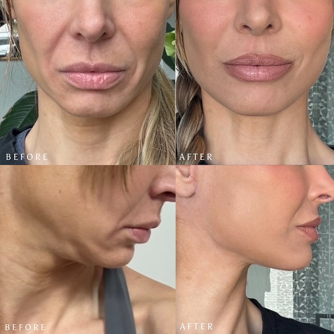 Instagram post by Dr. John Layliev: I’ve been getting a lot of facelift requests from younger patients lately. If there is room for significant improvement, then I’m all for it…