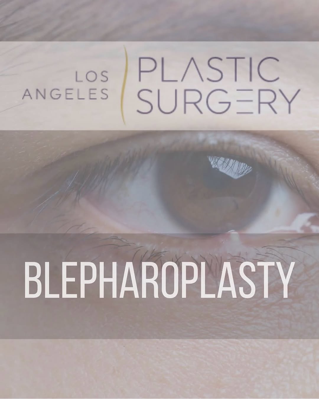 Instagram post by Dr. John M. Anastasatos: Your eyelids frame your beautiful eyes and can impact how the world views your appearance. Droopy upper eyelids can make you look tired or l…
