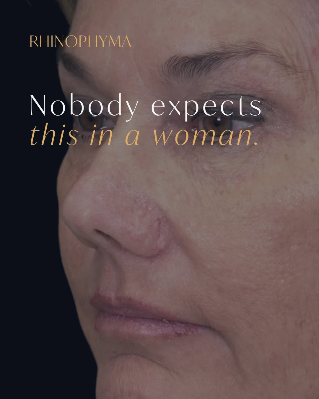 Instagram post by Dr. John M. Hilinski: Nobody expects this in a woman. Rhinophyma is the advanced stage of rosacea. The oil glands and connective tissue in the skin of the nose gr…