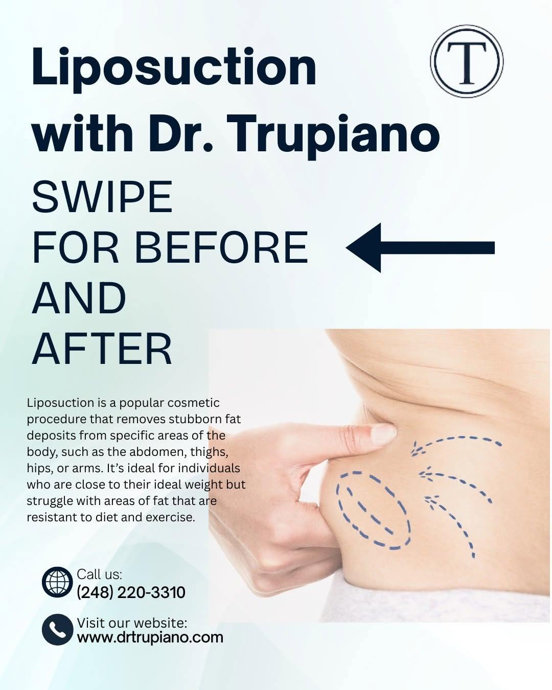 Instagram post by Dr. John M. Trupiano: Liposuction permanently removes fat cells from the treated area, but it does not prevent future weight gain. If your weight changes, the rem…