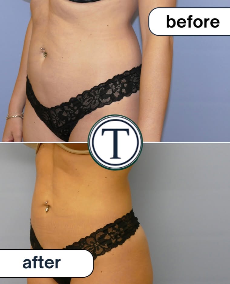 Instagram post by Dr. John M. Trupiano: One of the most common concerns patients have before liposuction is whether loose skin will remain after fat is removed. The answer depends …