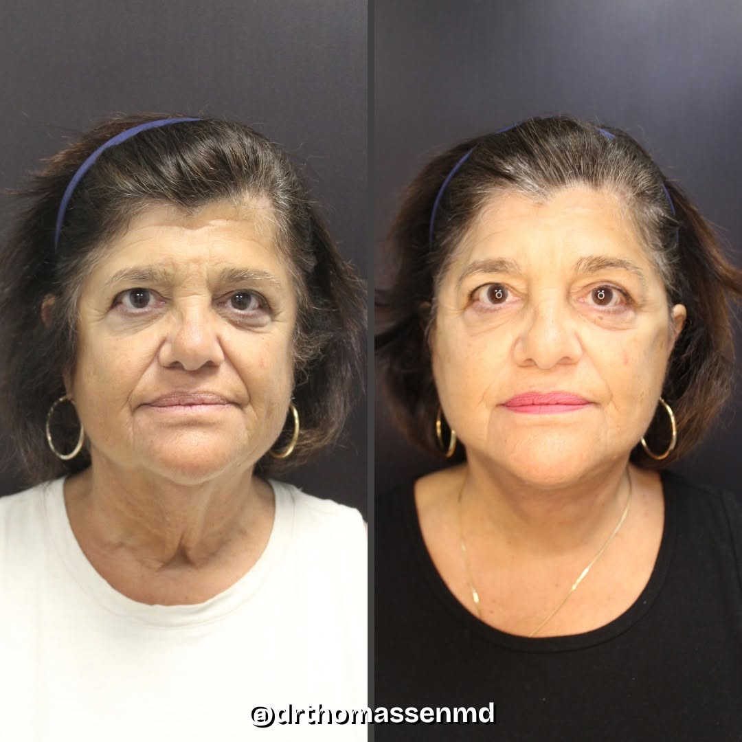 Instagram post by Dr. John Michael Thomassen: The neck often shows early signs of aging - sagging skin, loss of definition, and deep creases. This patient underwent a deep plane facelift…