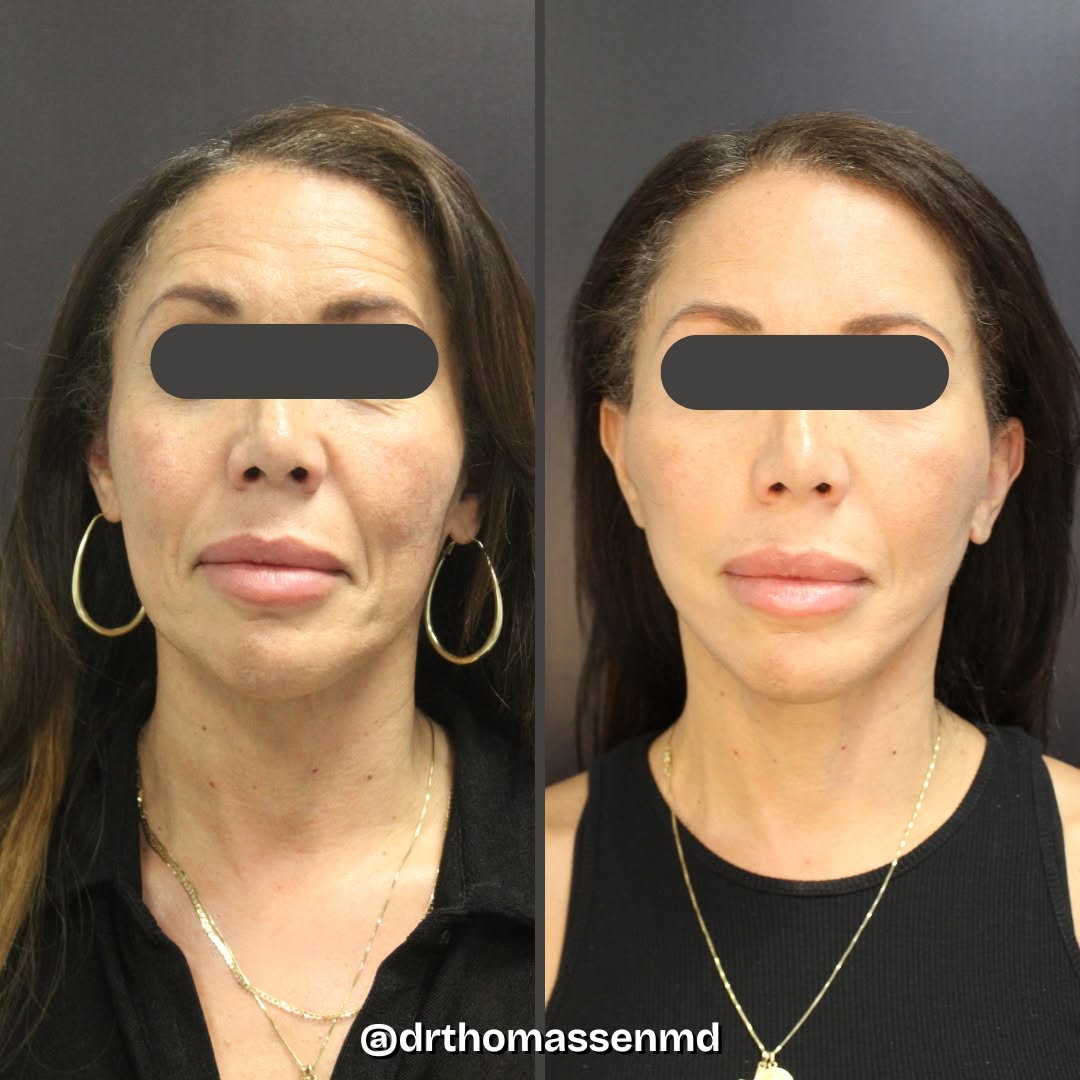 Instagram post by Dr. John Michael Thomassen: ✨ Stunning, natural rejuvenation with a deep plane mini facelift ✨ Notice the refined jawline, lifted cheeks, and smoother lower face — all …