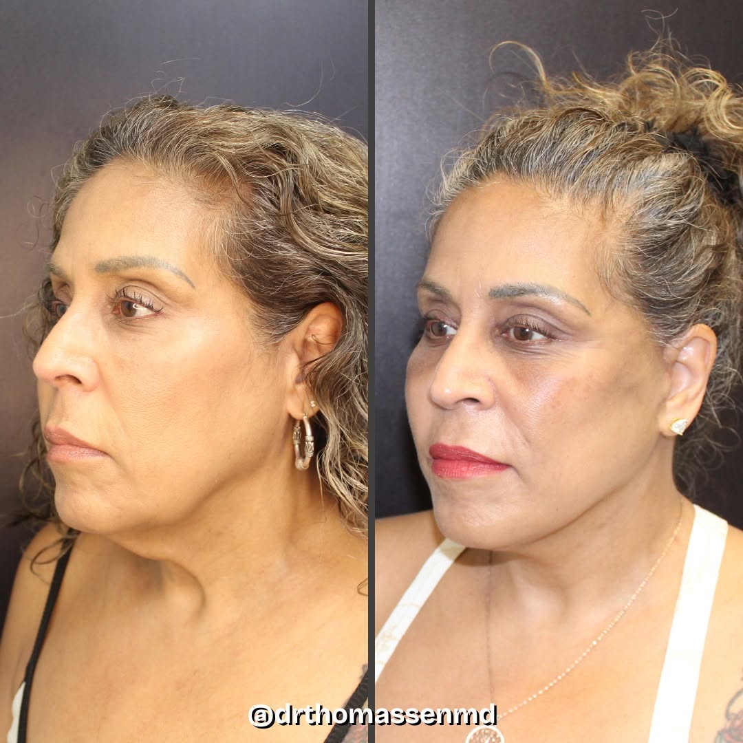 Instagram post by Dr. John Michael Thomassen: Another happy patient, another stunning, natural lift! This patient underwent a deep plane mini facelift for a refreshed look, defined jawli…