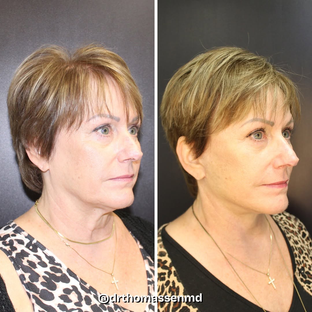 Instagram post by Dr. John Michael Thomassen: When it comes to facial rejuvenation, technique matters. A Deep Plane Face & Neck Lift restores youthful contours without the pulled look. R…