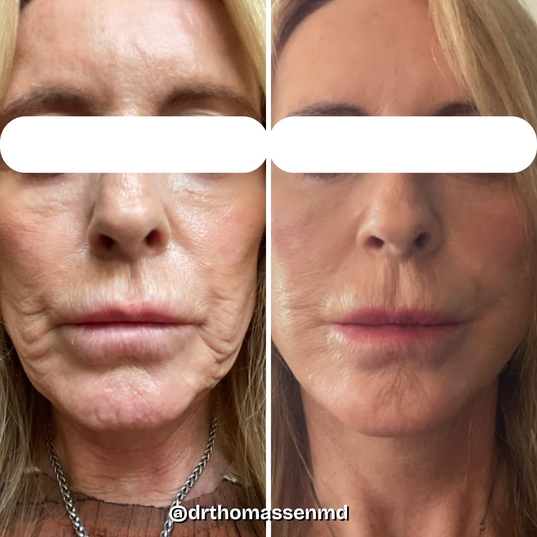 Instagram post by Dr. John Michael Thomassen: Check out these incredible results! 📸 Photo updates sent by our lovely patient following a deep plane facelift with facial fat grafting. Be…