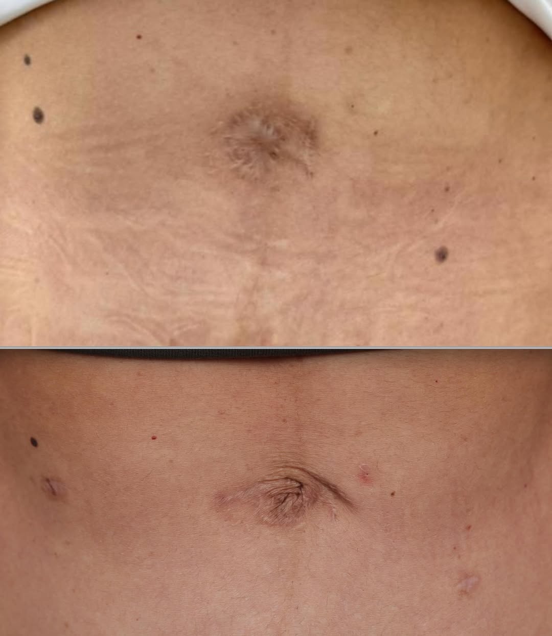 Instagram post by Dr. John Milam Shamoun: Something that looks so easy in plastic surgery can actually be very difficult. There has been a growing trend toward excising the native um…