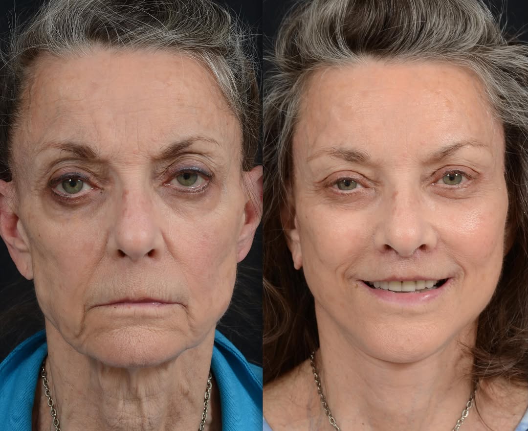 Instagram post by Dr. John Milam Shamoun: Cases that truly test a plastic surgeon’s skill are almost never the ones you see on social media. Most before-and-after photos feature youn…