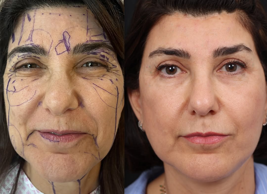 Instagram post by Dr. John Milam Shamoun: Beautiful and delightful 60+ year old from eastern part of Arab world . Almost two years after facial rejuvenation while working in Dubai . …