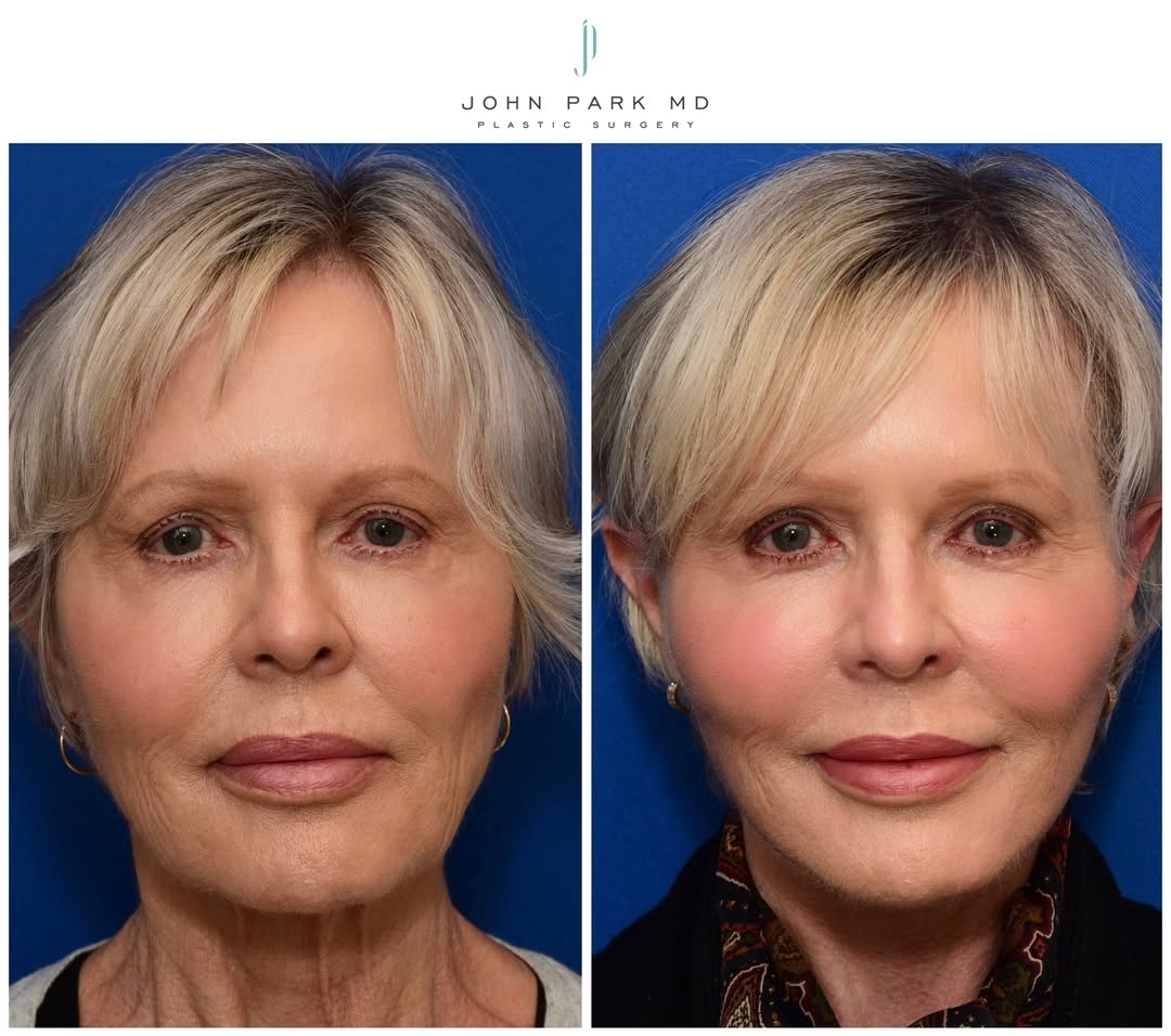 Instagram post by Dr. John Park: Say 👋 to timeless beauty following the face and neck lift, facial fat grafting and chemical peel! Call us at 949-777-6883 to set up your co…