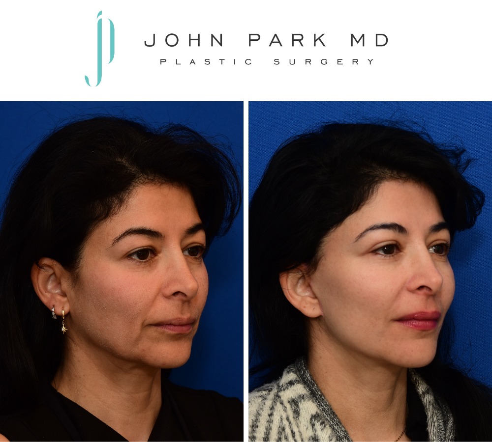 Instagram post by Dr. John Park: Here are the stunning results of a deep plane face and necklift, upper eyelid blepharoplasty, and facial fat grafting on this beautiful pati…