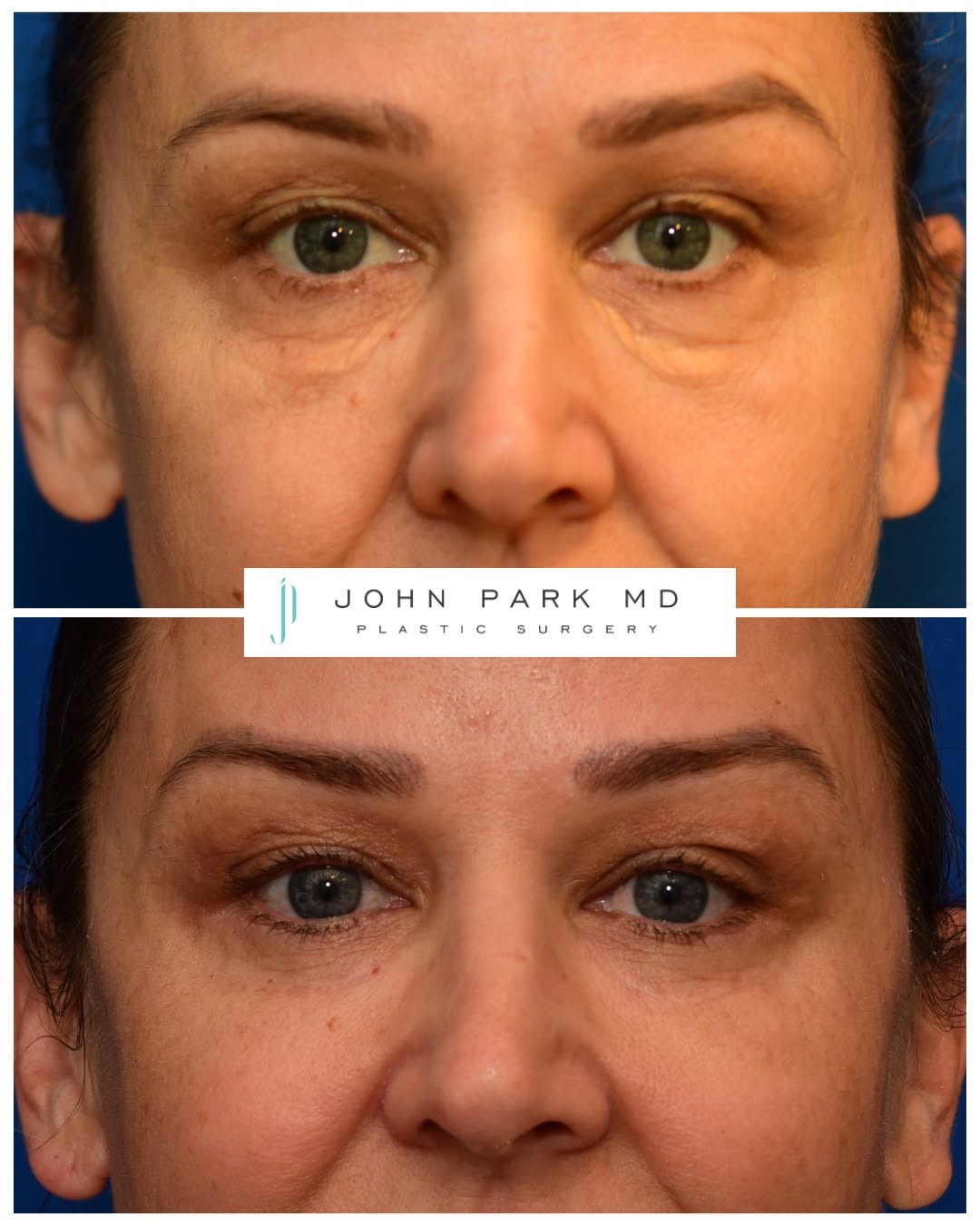 Instagram post by Dr. John Park: This beautiful patient presented with xanthelasma at her under eyes. Xanthelasma is a benign skin condition characterized by yellowish depos…