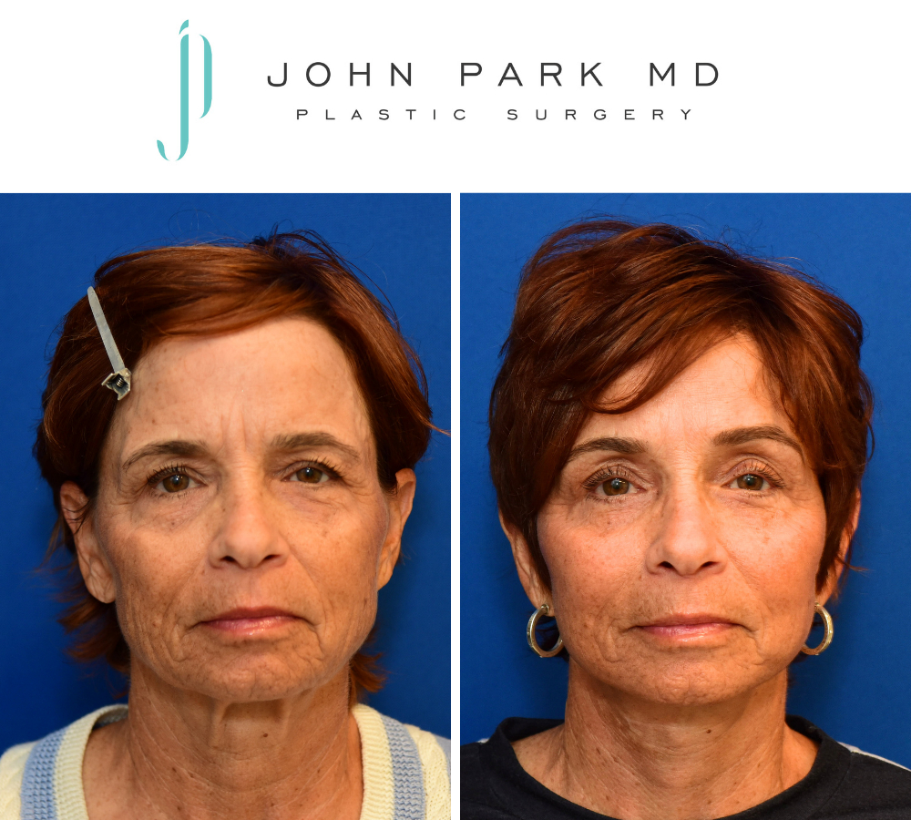 Instagram post by Dr. John Park: Natural while impactful results for a refreshed appearance were achieved with the following procedures: ➡️deep-plane face and neck lift ➡️up…