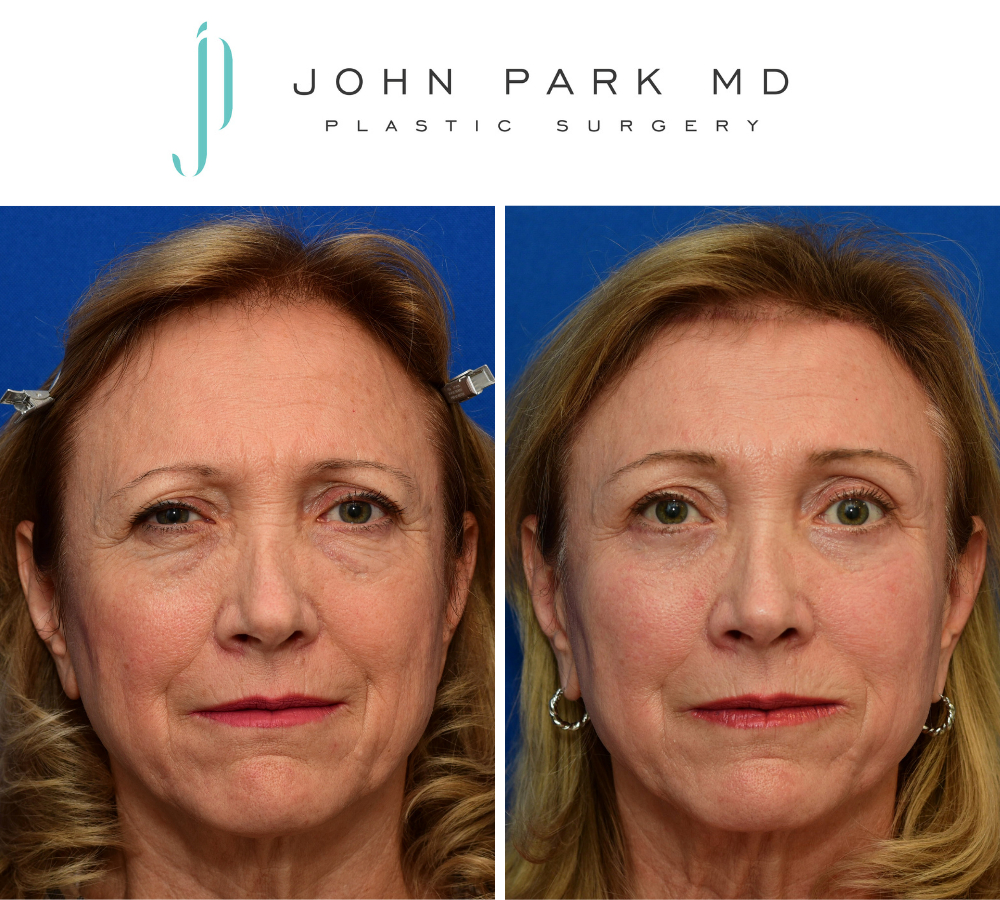 Instagram post by Dr. John Park: A pretrichial brow lift (also referred to as a hairline brow lift) helps bring youth and symmetry to this lovely patient by opening up the e…