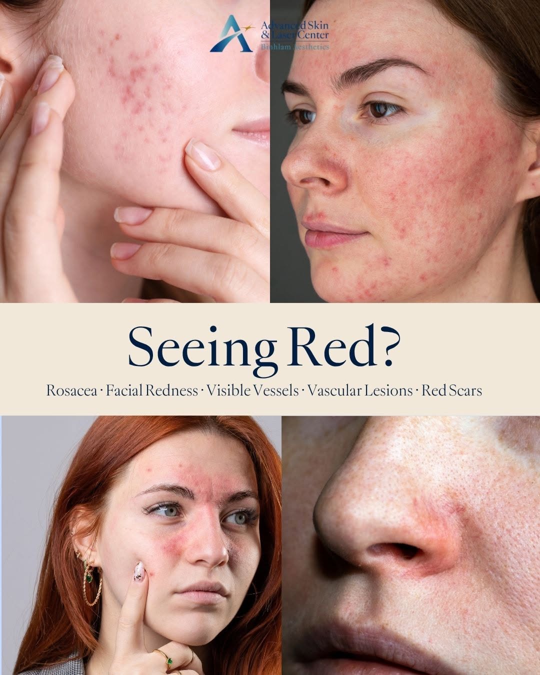 Instagram post by Dr. John Q. Binhlam: Your skin, our passion™ Ready to address your redness? VBeam is a pulsed dye laser designed to target blood vessels beneath the skin while l…