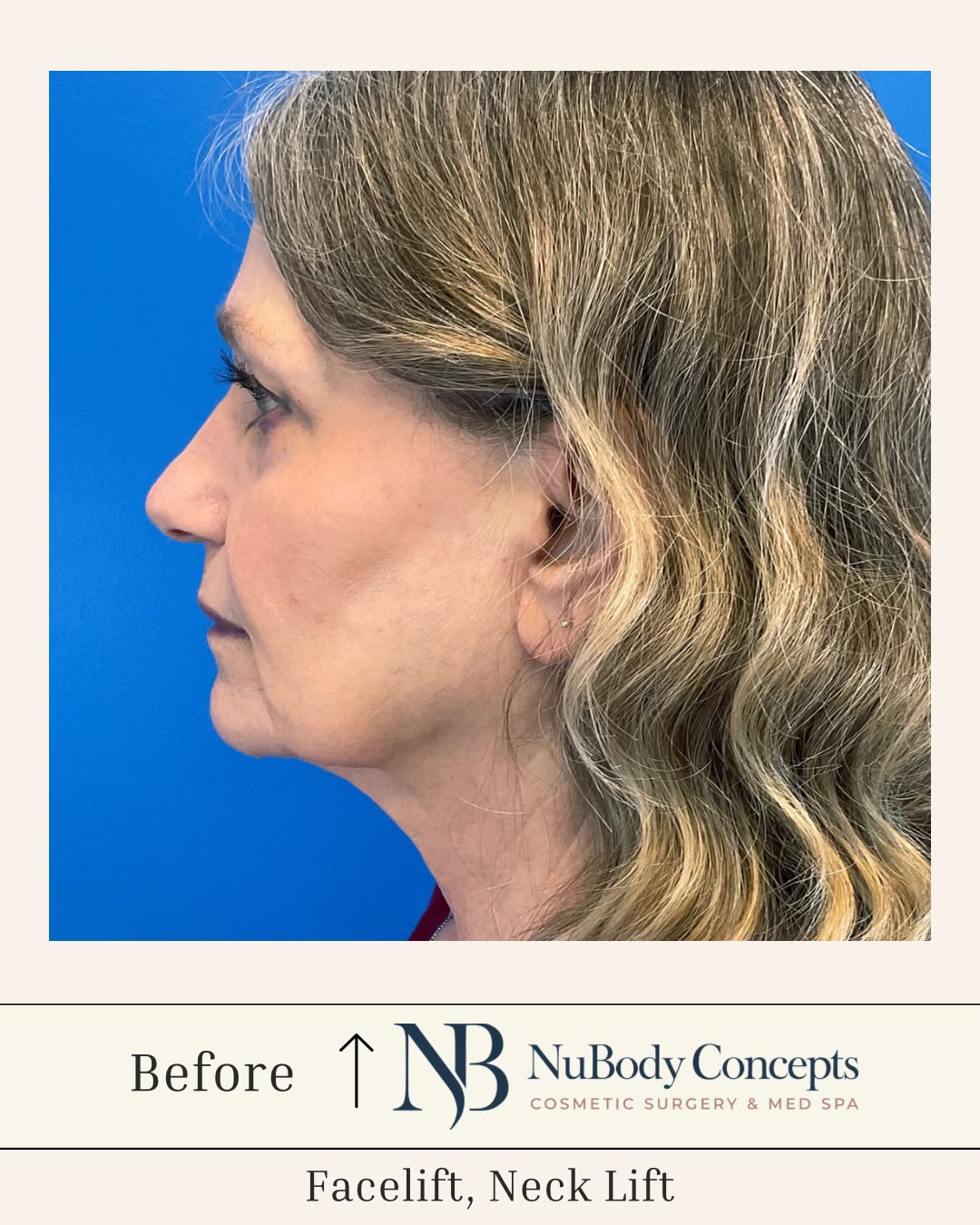 Instagram post by Dr. John Rosdeutscher: Confidence looks good from every angle! ⭐️ This facelift and neck lift transformation is a beautiful example of how the right surgical appro…