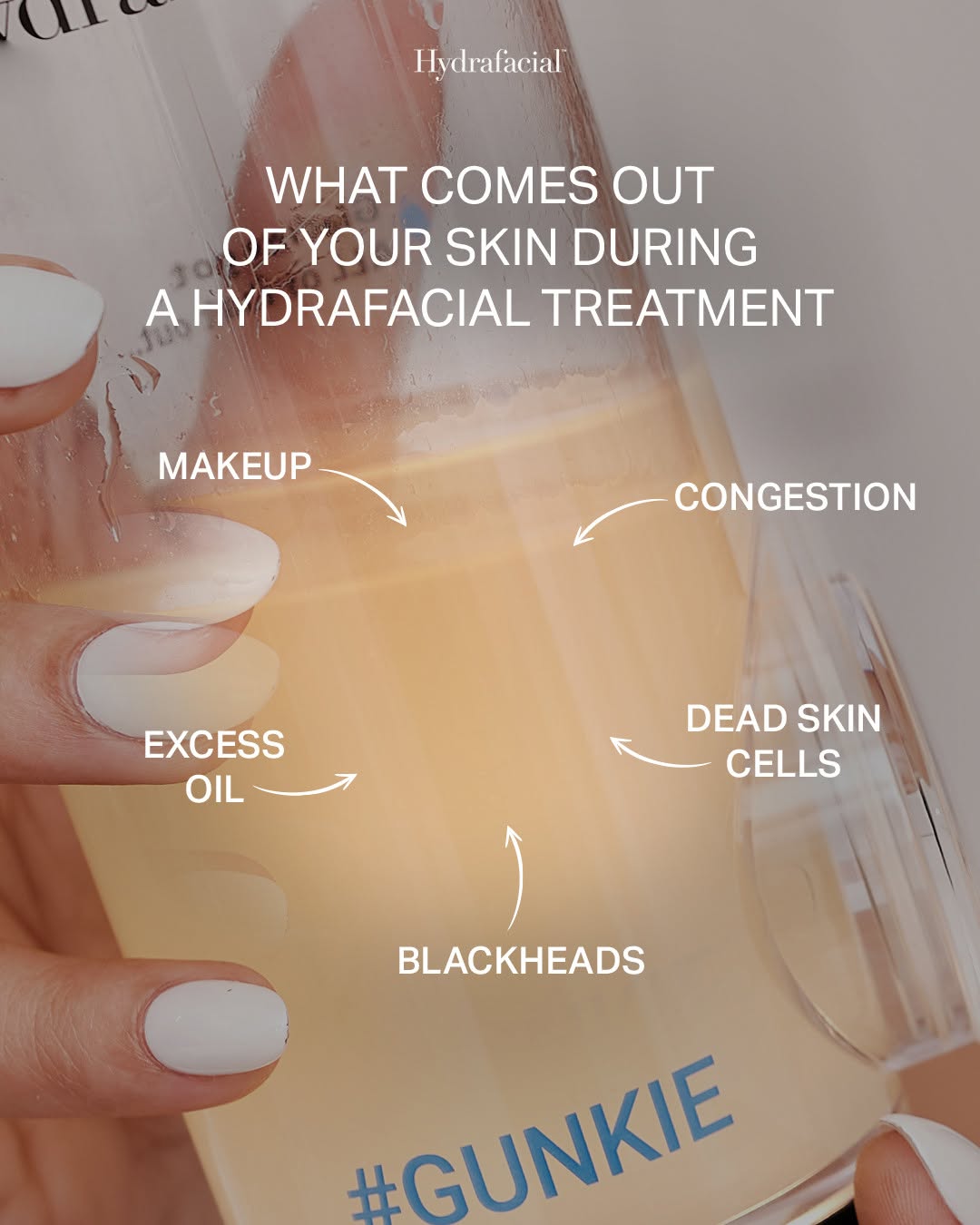 Instagram post by Dr. John Rosdeutscher: This is what we call the "Gunkie Jar" The literal proof of a successful Hydrafacial treatment! It’s a mix of everything that was standing be…