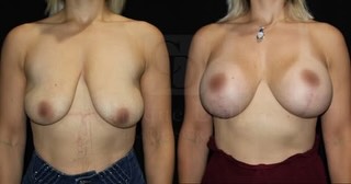 Instagram post by Dr. John W. Antonetti: We love to see the best transformation our wonderful patients go through. This lovely lady was so happy to enhance the appearance of her bre…