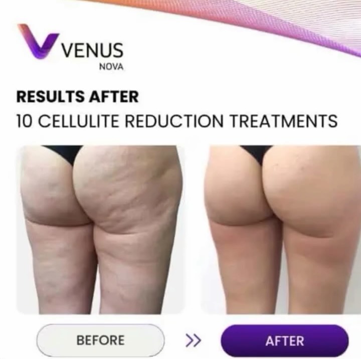 Instagram post by Dr. John W. Gillespie III: Ready to trim, tone and transform your body the relaxing way? Experience the ultimate in skin tightening and body contouring with our new te…