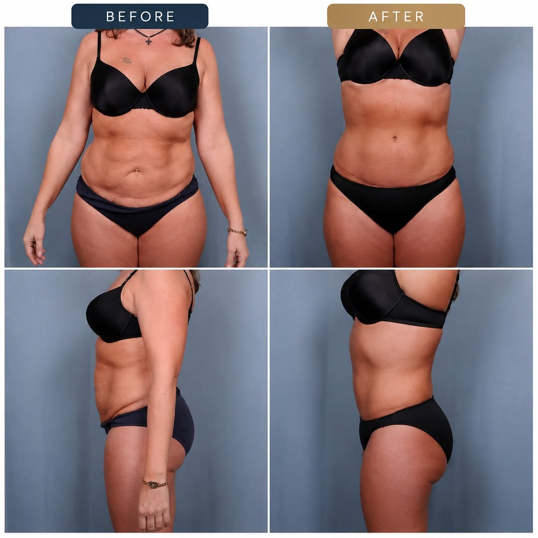 Instagram post by Dr. John Zannis: ✨ Patient Goal → Restore Confidence After Weight Loss. NOT AI After significant weight loss, excess skin can hide the incredible progress yo…