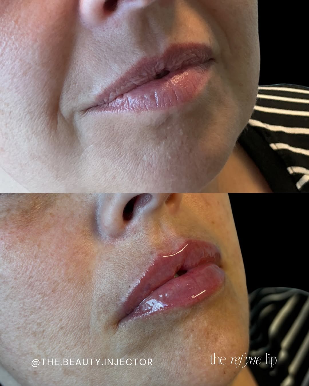 Instagram post by Dr. Johnny J. Peet: Just revived these beautiful lips 👄 ✨ My books have been filling up with the holidays approaching! If your lips have been asking for some T…
