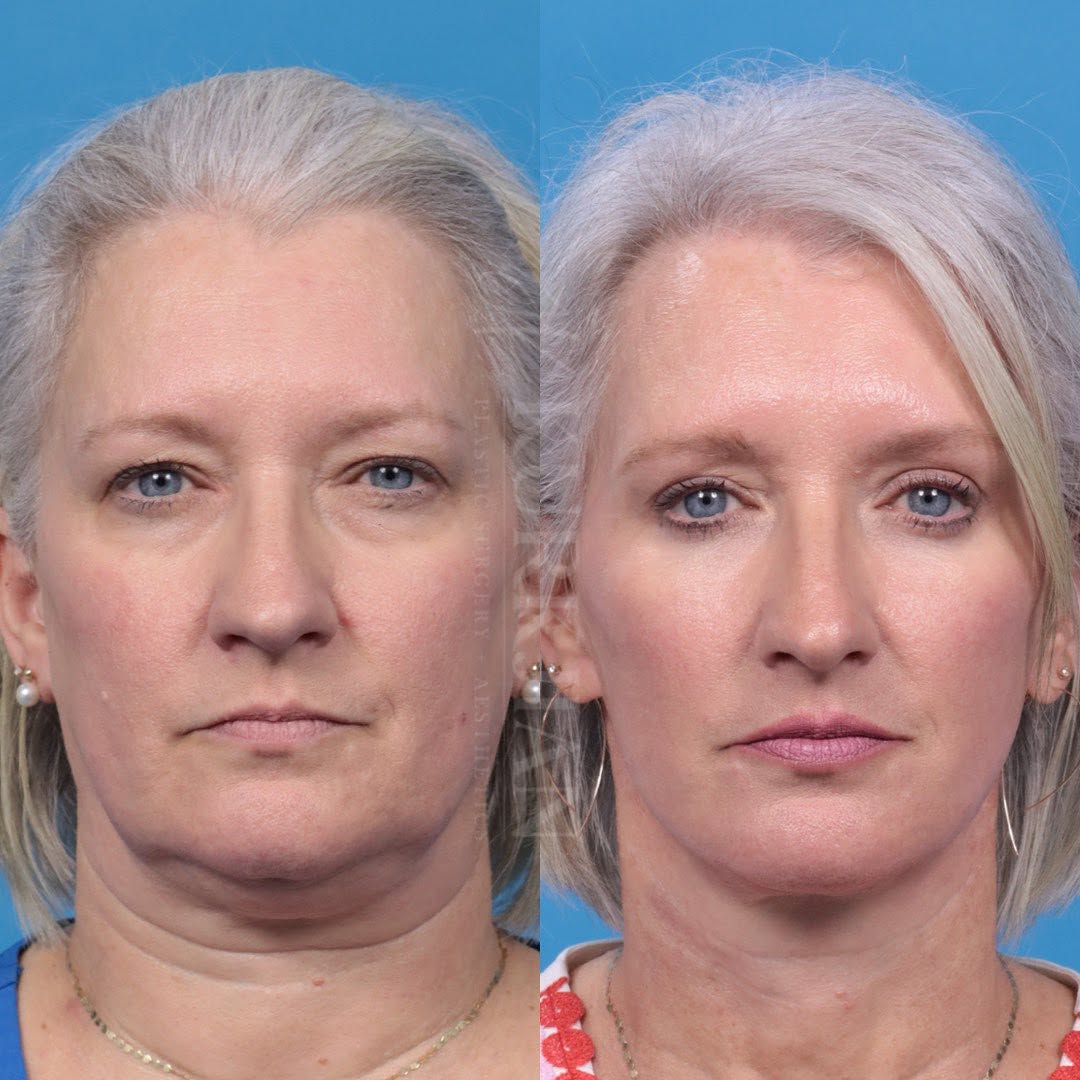 Instagram post by Dr. Jon Kurkjian: One year following her facial rejuvenation, this sweet patient radiates timeless beauty and elegance. I love how her look is refreshed and r…