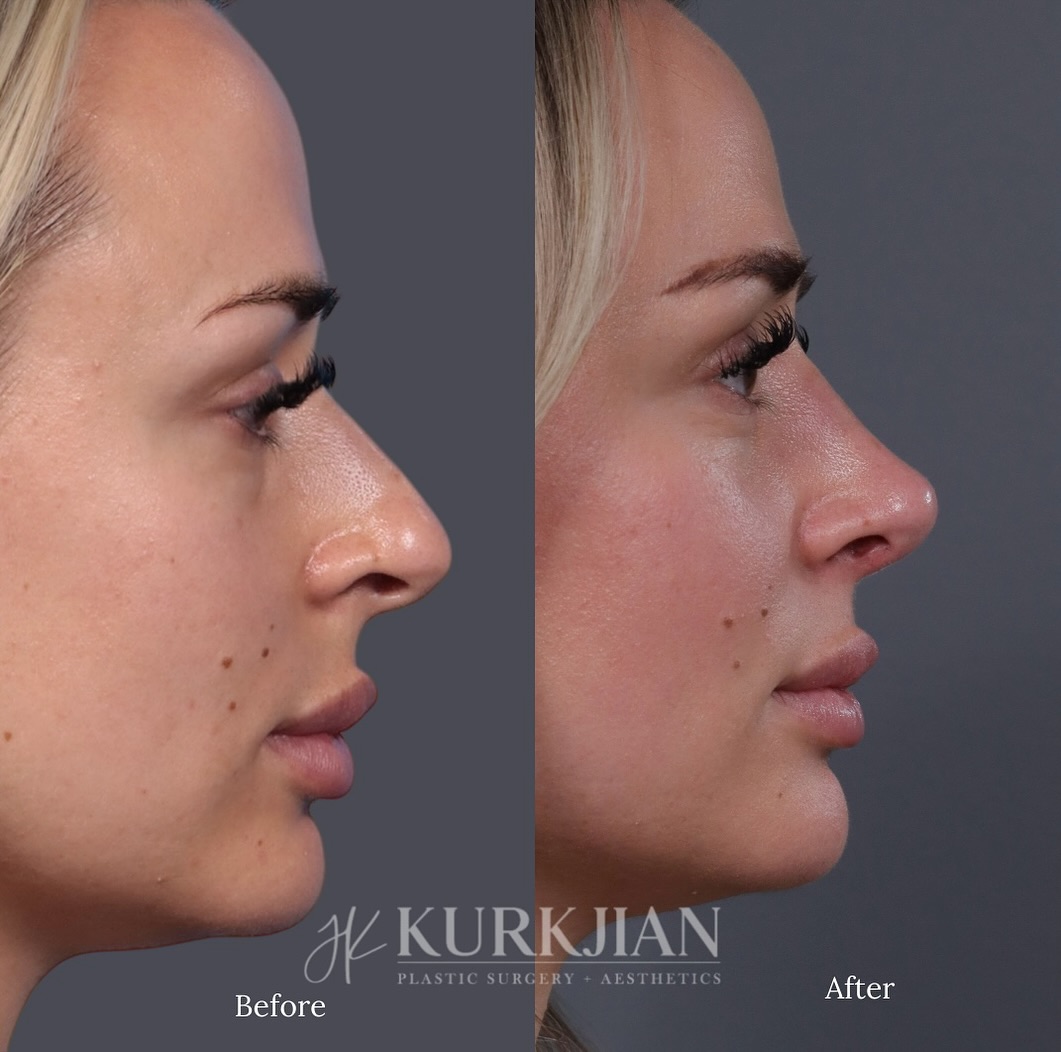 Instagram post by Dr. Jon Kurkjian: 6 month update after rhinoplasty. I love that we were able to refine her nose and achieve a more feminine shape while still staying true to …