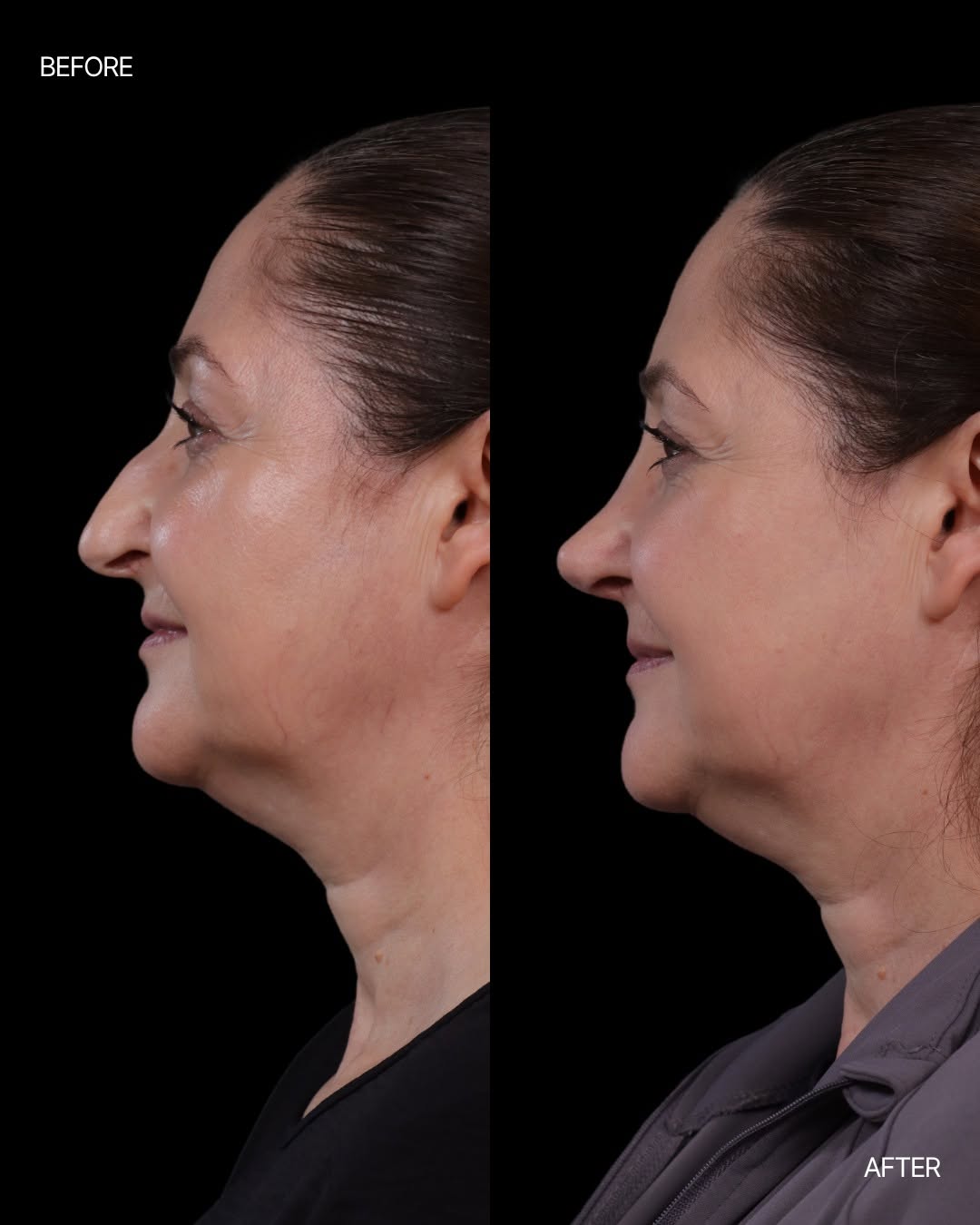 Instagram post by Dr. Jon Kurkjian: Rhinoplasty is not about changing the face; it’s about improving proportion, balance, and harmony while respecting each patient’s individual…