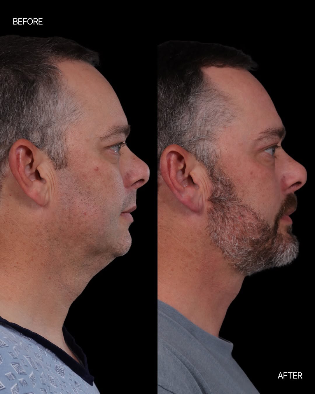 Instagram post by Dr. Jon Kurkjian: This result shows the impact of addressing multiple areas of facial aging at once. ㅤ A short-scar neck lift, chin augmentation, and upper bl…