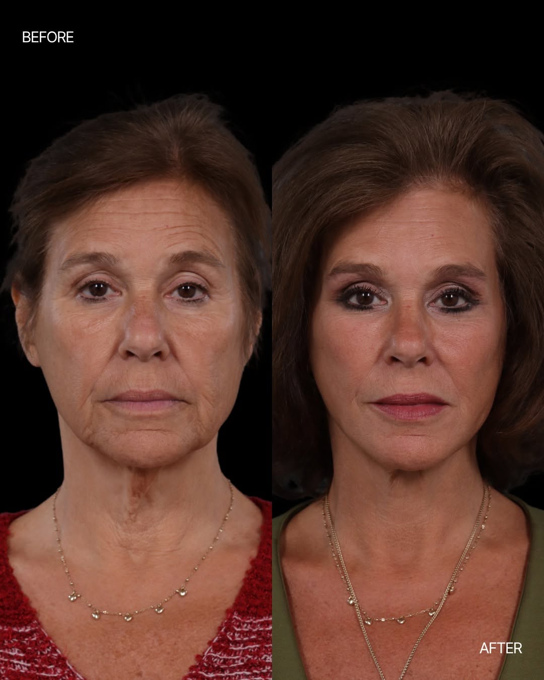 Instagram post by Dr. Jon Kurkjian: Facial aging rarely happens in just one area, which is why comprehensive rejuvenation may involve more than one procedure. ㅤ For this patien…