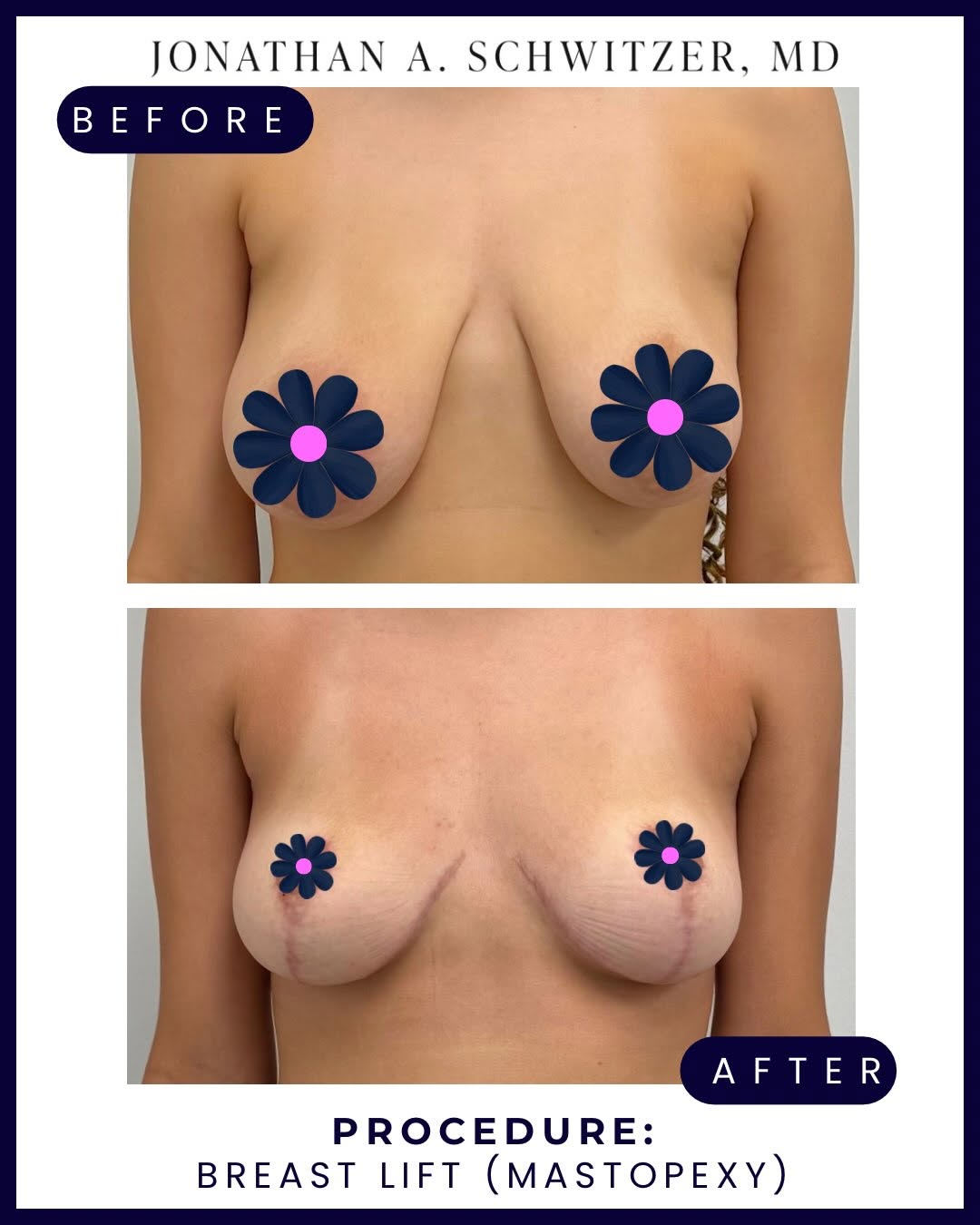 Instagram post by Dr. Jonathan A. Schwitzer: Restoring shape, position, and proportion. This patient underwent a mastopexy (breast lift) to elevate and reshape the breasts, improve nipp…
