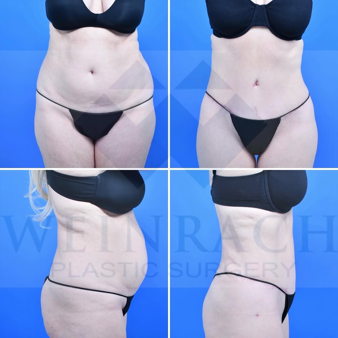 Instagram post by Dr. Jonathan C. Weinrach: 60 year old woman who is now two months out from a tummy tuck, SAFELipo of her flanks and back. #weinrachplasticsurgery #tummytuckbeforeanda…