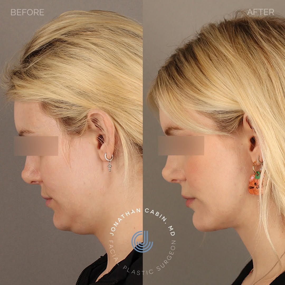 Instagram post by Dr. Jonathan Cabin: A beautiful transformation for a beautiful patient, shown 7 months after a deep, structural neck lift with buccal fat reduction for lower fa…
