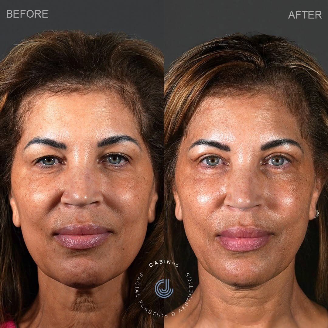 Instagram post by Dr. Jonathan Cabin: Early recovery for an eye opening upper bleph with ptosis repair 👀 ⠀⠀⠀⠀⠀⠀⠀⠀⠀ Upper bleph (“eyelid lift”) treats upper lid skin excess. ⠀⠀⠀⠀…