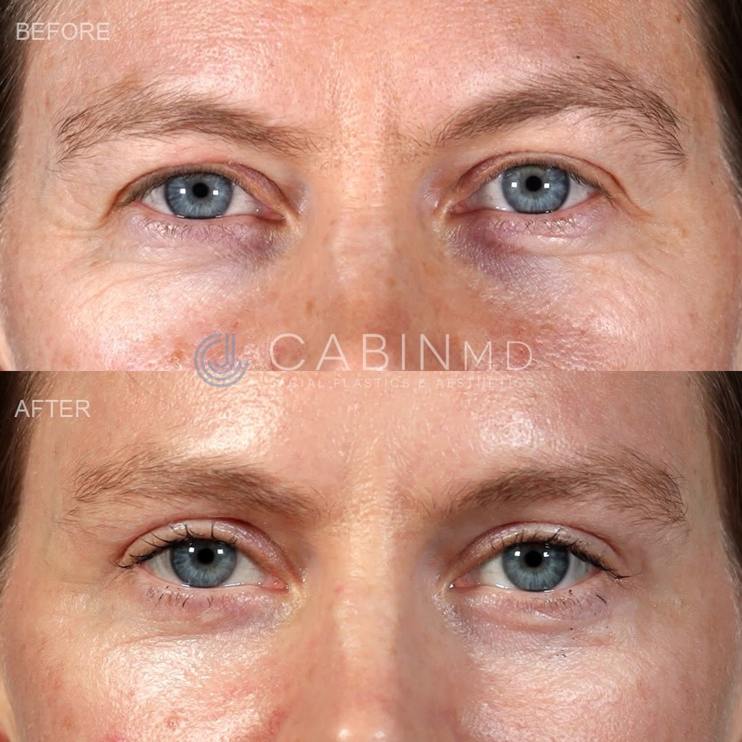 Instagram post by Dr. Jonathan Cabin: This incredible soul is 10 months out from a subtle but comprehensive upper face refresh - a beautiful example of how small, targeted change…