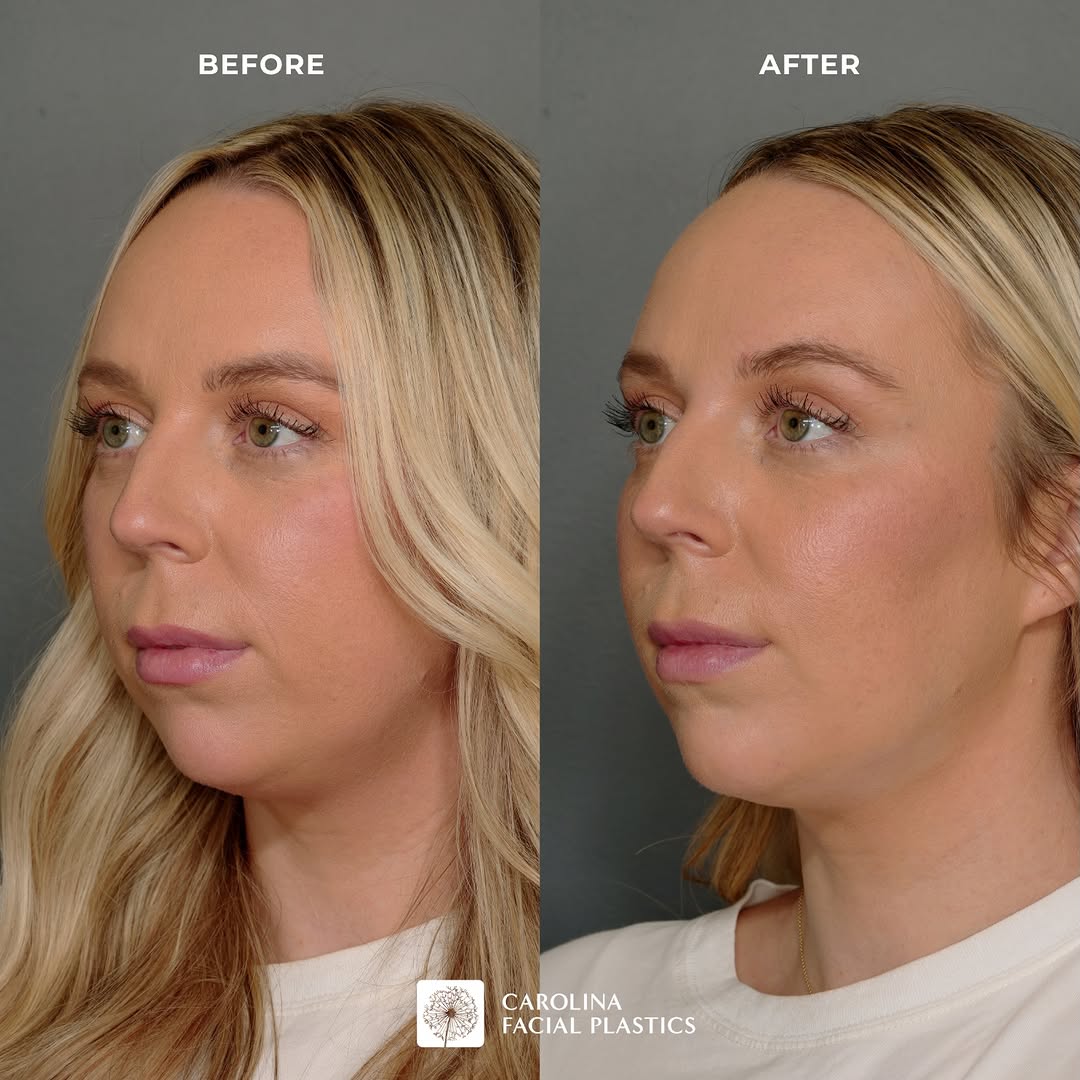 Instagram post by Dr. Jonathan Kulbersh: A little more definition, a lot more balance 💉 Chin Filler performed by @courtneywhitley_np Chin filler is a wonderful solution for anyone …