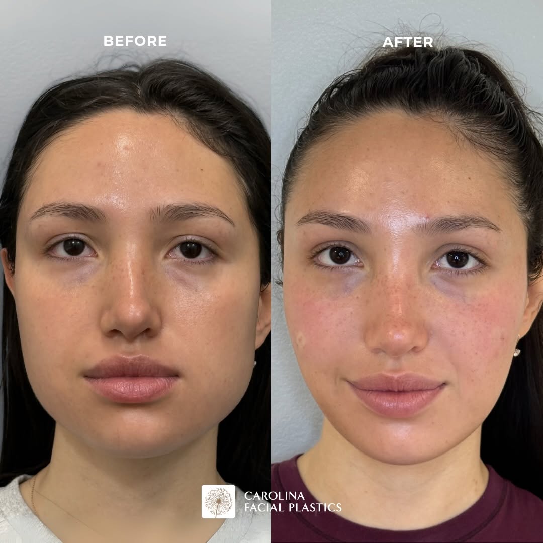 Instagram post by Dr. Jonathan Kulbersh: FACE SLIMMING TOX 💉 Also known as Masseter Botox! Did you know that this treatment has both cosmetic and medical benefits? Overactivity of …