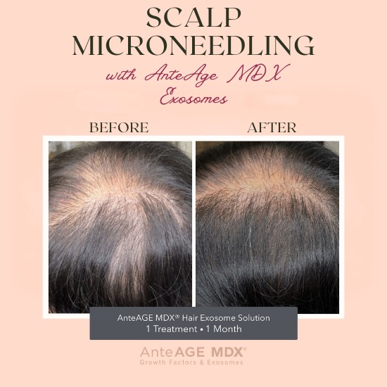 Instagram post by Dr. Jonathan Landon: ✨ Hair Restoration in Action! ✨ Check out these incredible before and after results from scalp microneedling with **AnteAge MDX Hair Exosome…